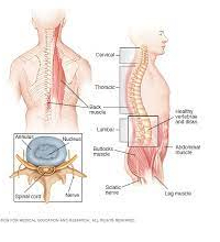Spine Cord Tumor